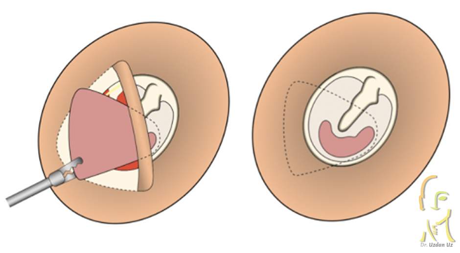 Kulak Zarı Tamiri (Miringoplasti)