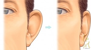 Kepçe Kulak Ameliyatı (Otoplasti)