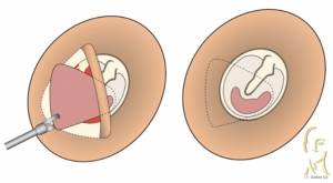 Kulak Zarı Tamiri (Miringoplasti)