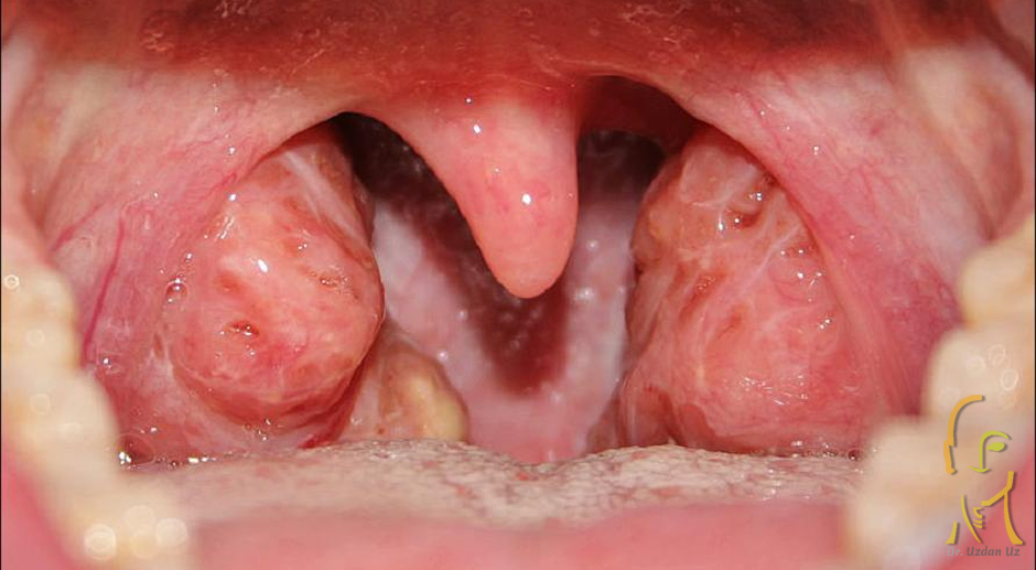 Bademcik Büyümesi (Tonsil Hipertrofisi)