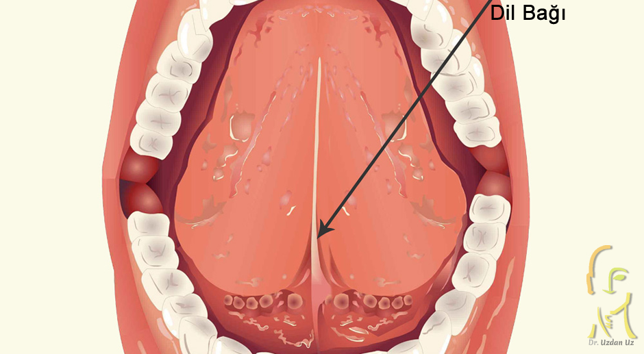 Dil Bağı (Ankiloglossi)