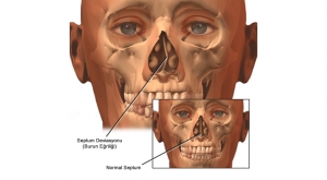 Burun Eğriliği (Septum Deviasyonu)