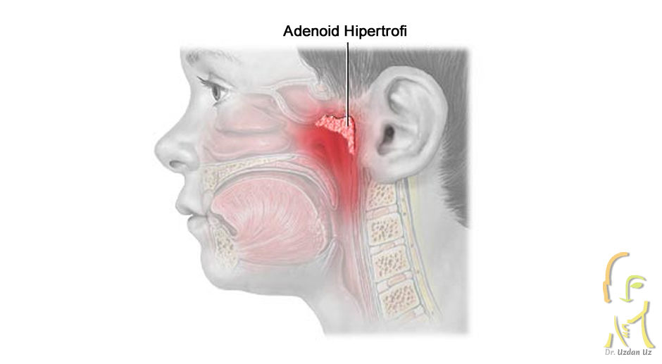 Geniz Eti (Adenoid Hipertrofisi)