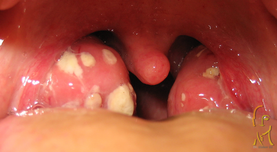 Bademcik Enfeksiyonu (Tonsillit)